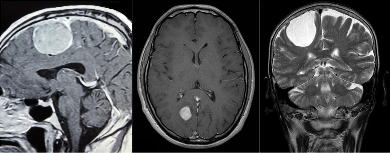 Brain Tumors