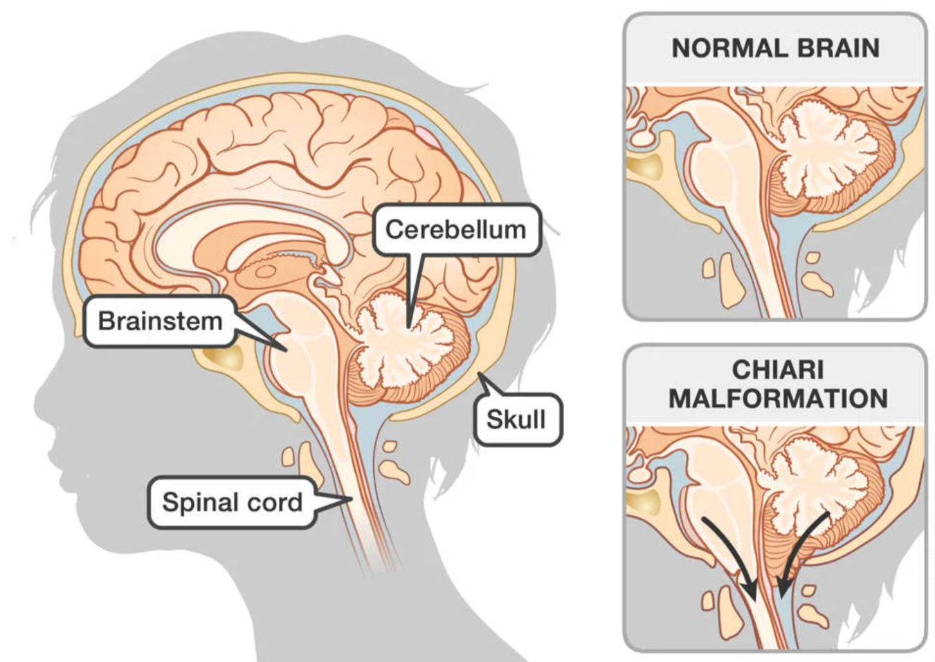 Chiari Malformation