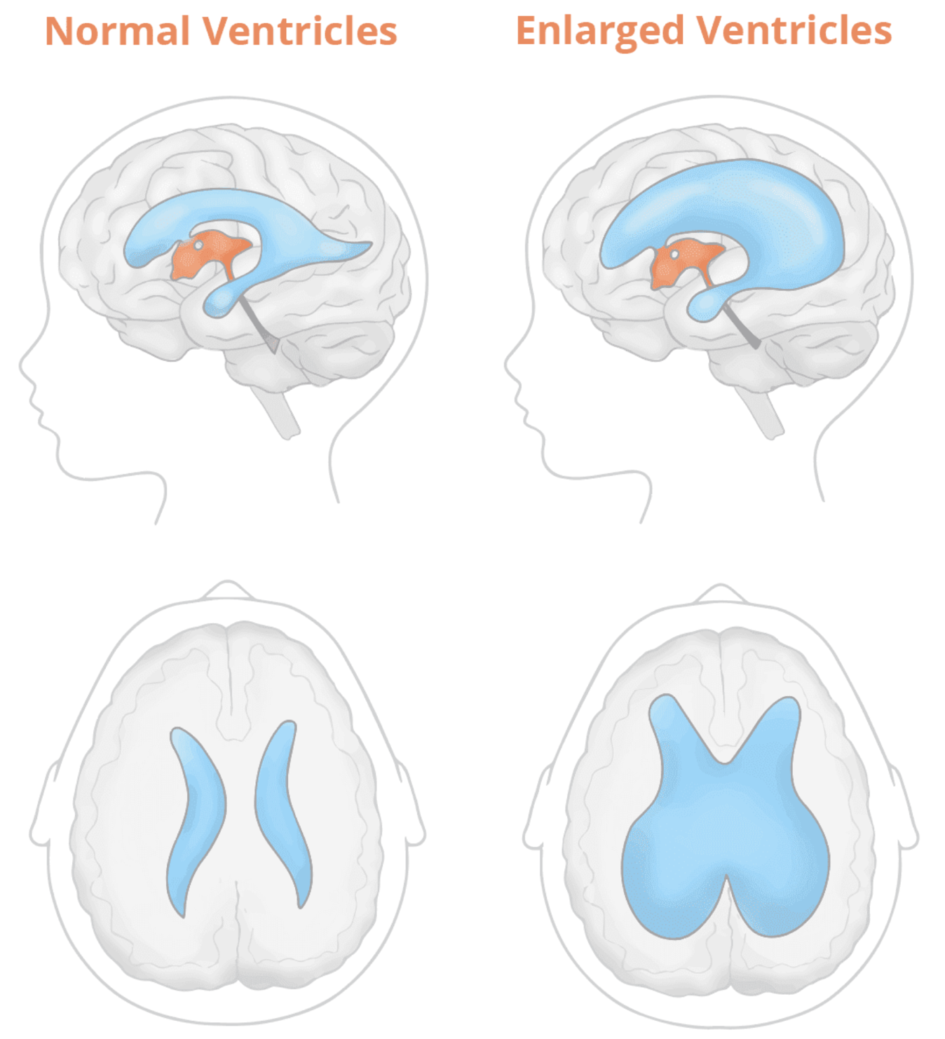 Hydrocephalus