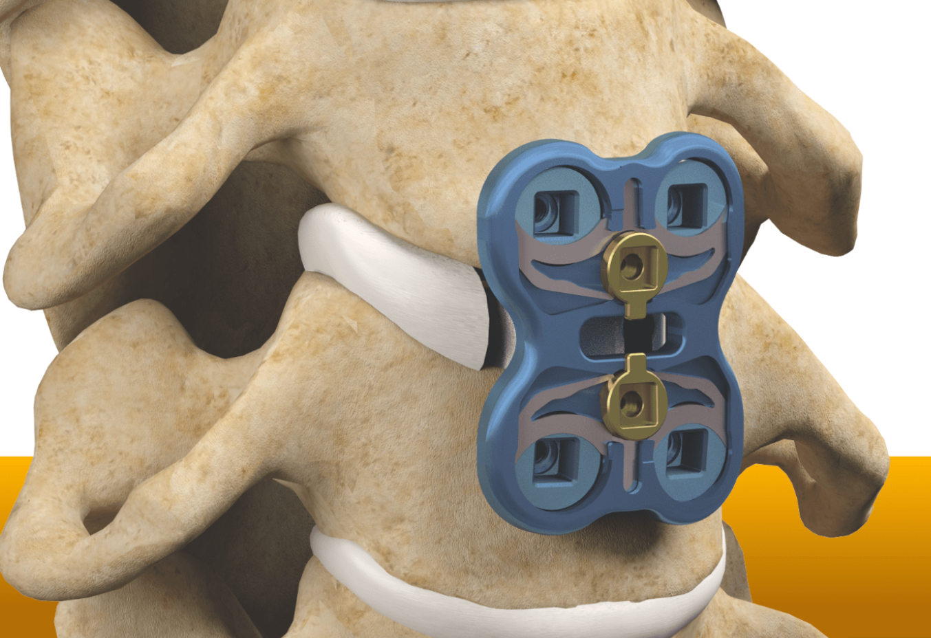 Artificial Disc Replacement