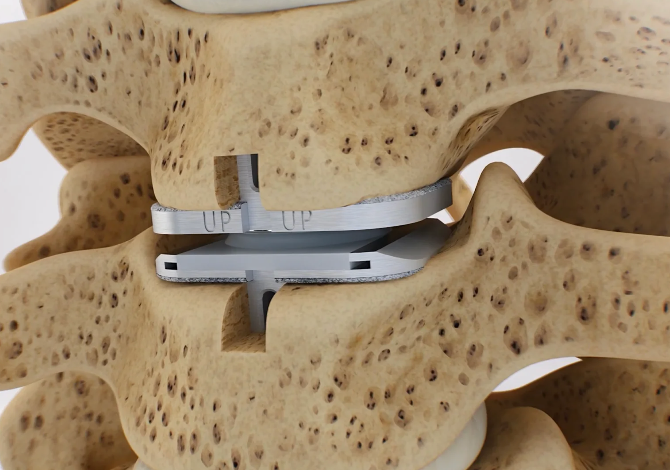 Cervical Discectomy & Fusion