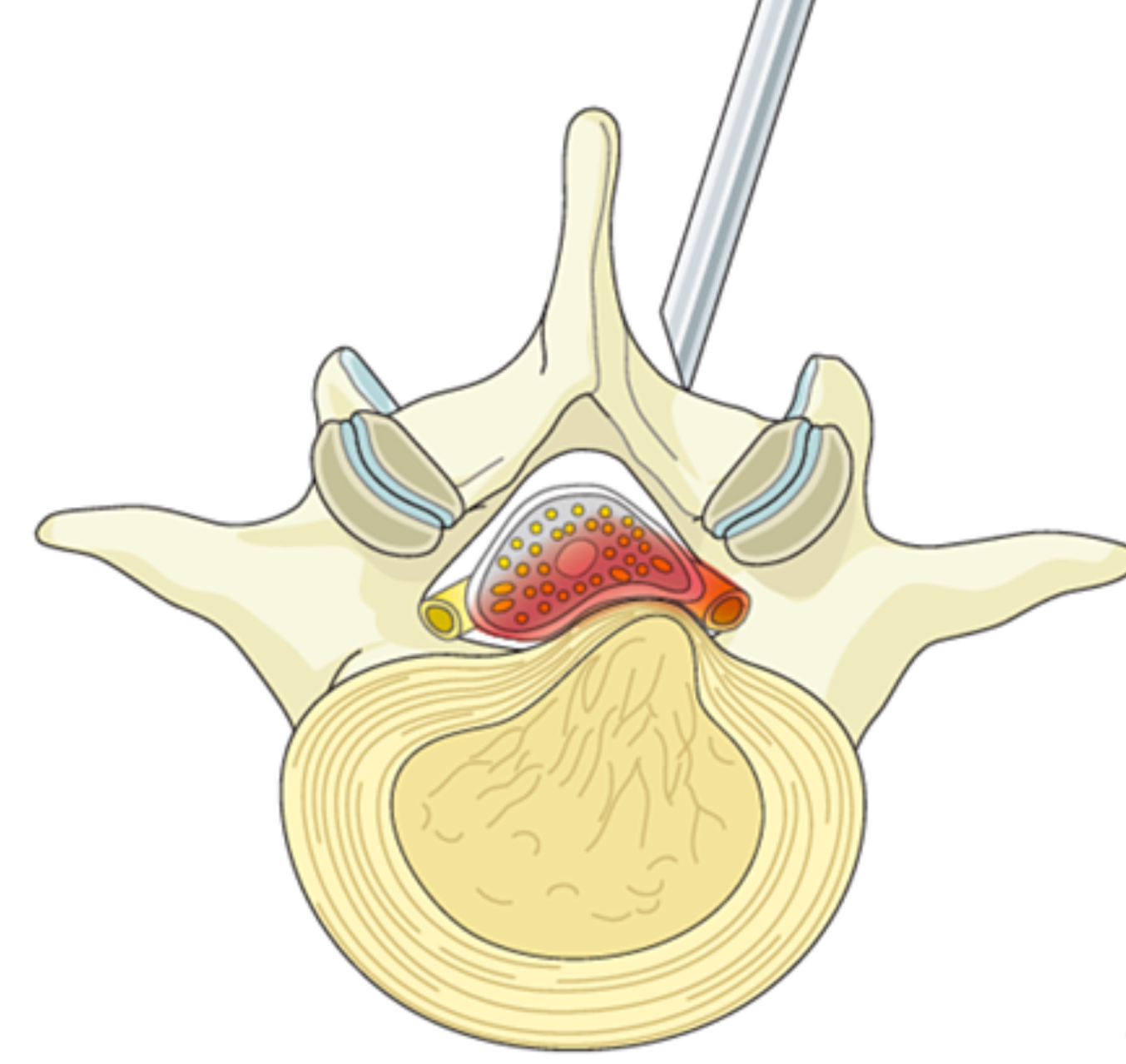 Lumbar Microdiscectomy