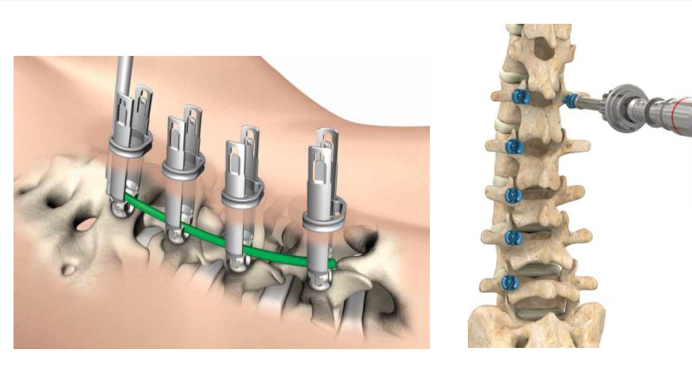 Minimally Invasive Spine Techniques