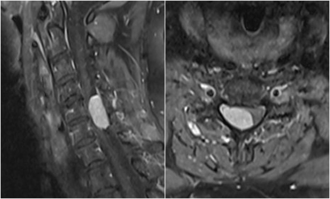 Spine Tumors Surgery