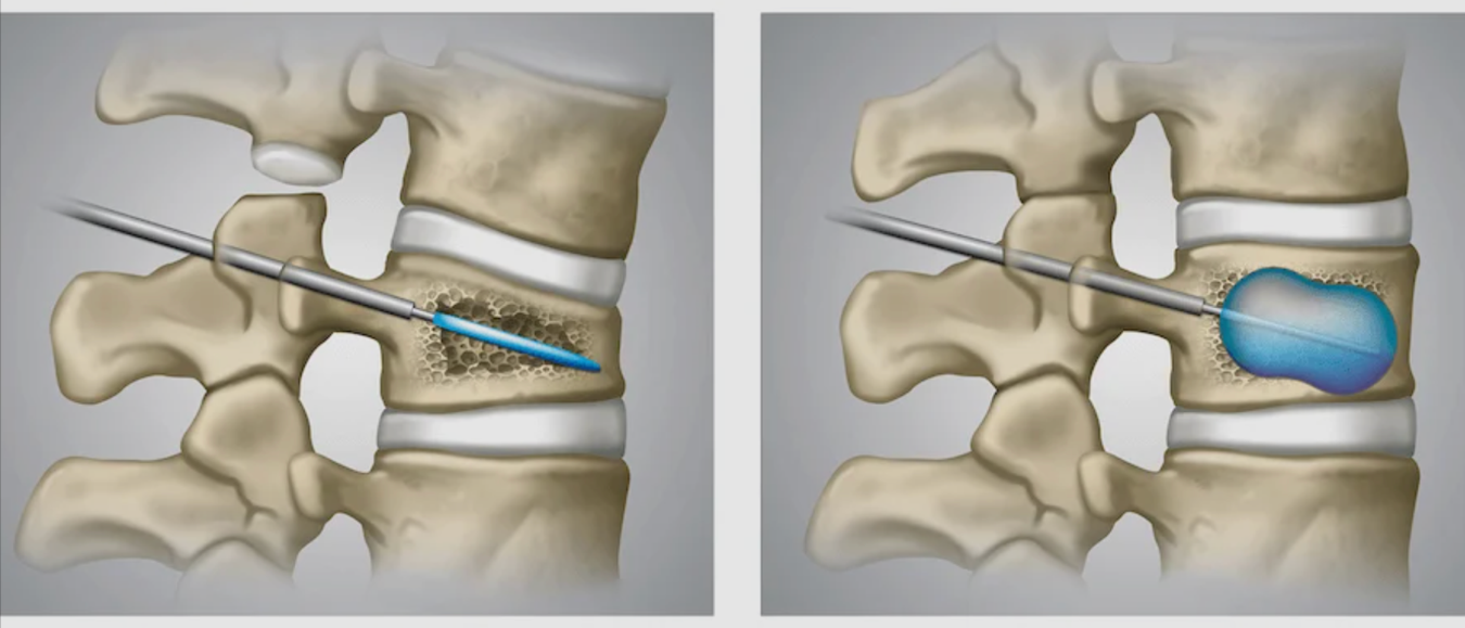 Kyphoplasty