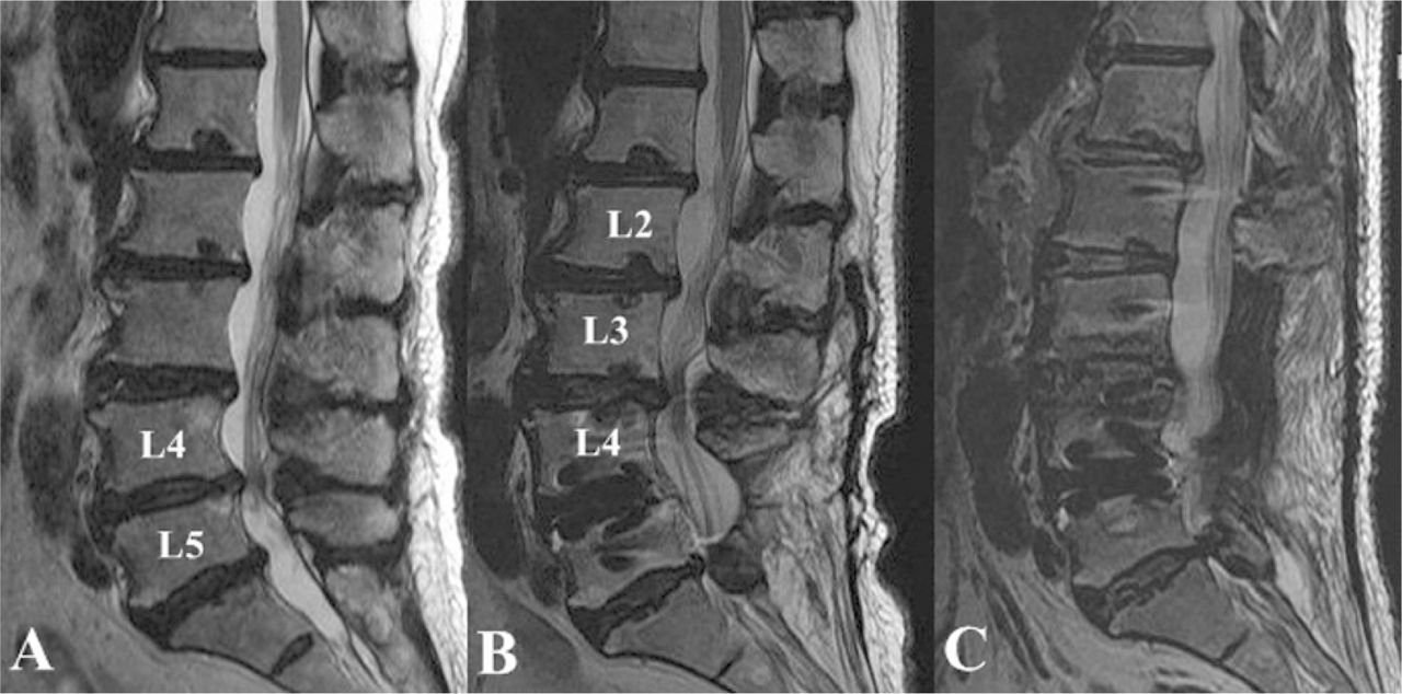 Revision Spine Surgery